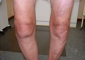 Cómo tratar la artrosis articular de la rodilla