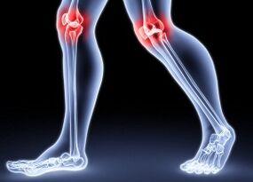 Razón Desarrollo segundo de la artrosis de la rodilla