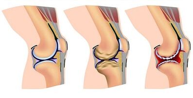 La etapa de desarrollo de la artrosis de la articulación de la rodilla