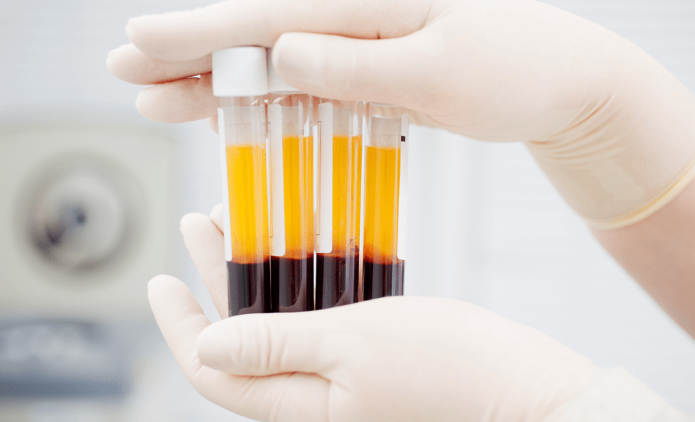 Plasma rico en plaquetas para la terapia con PRP en artrosis